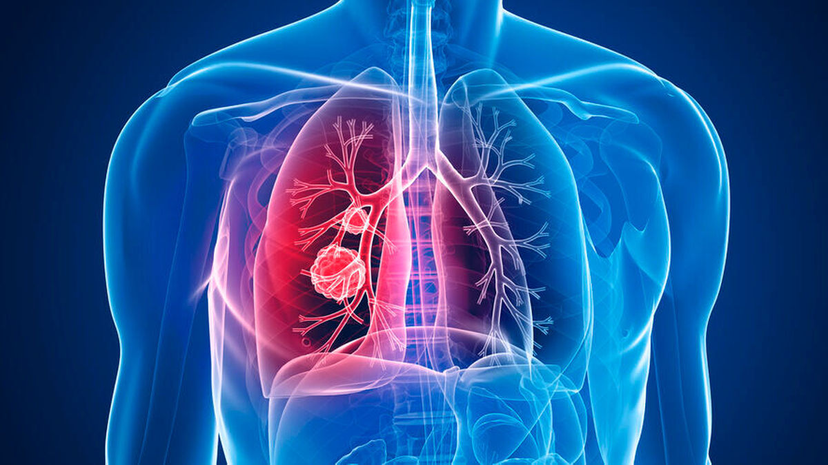 NSCLC: INTerpath-002-Studie zu mRNA-4157 + Pembrolizumab