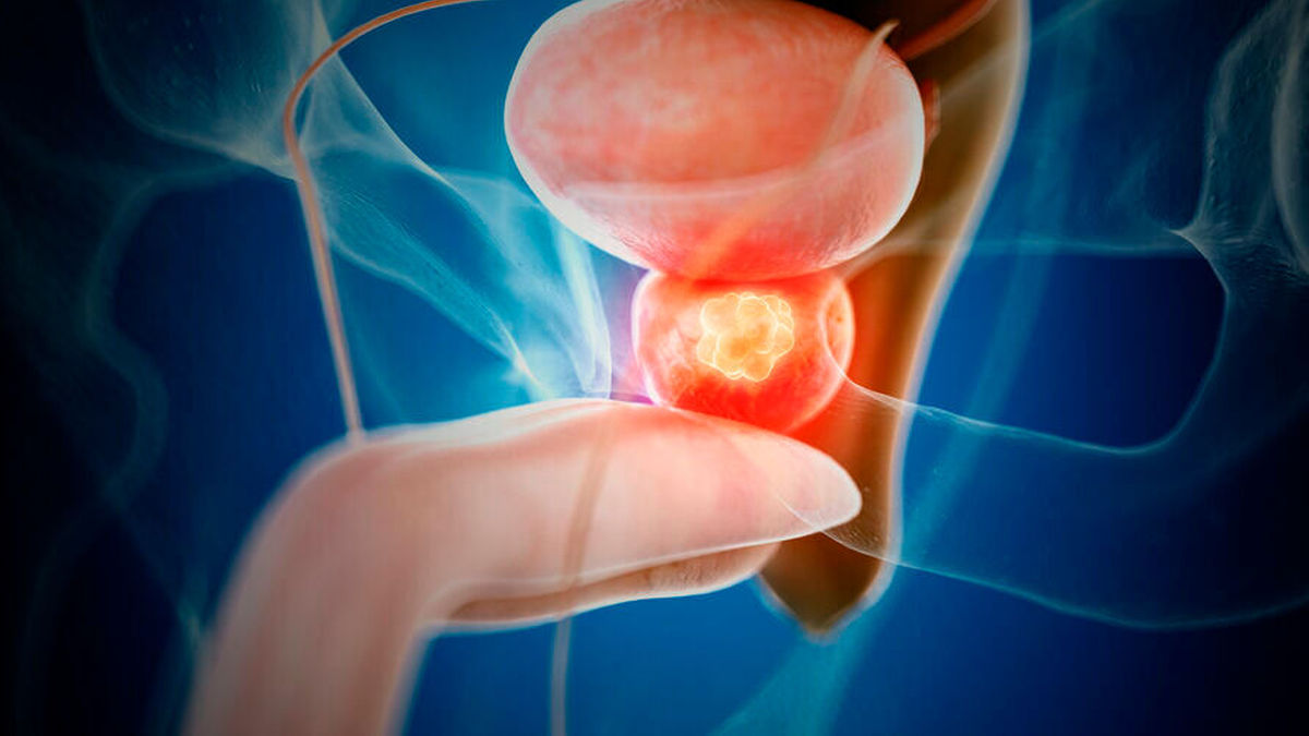Nmcrpc real world daten best tigen gute wirksamkeit von apalutamid