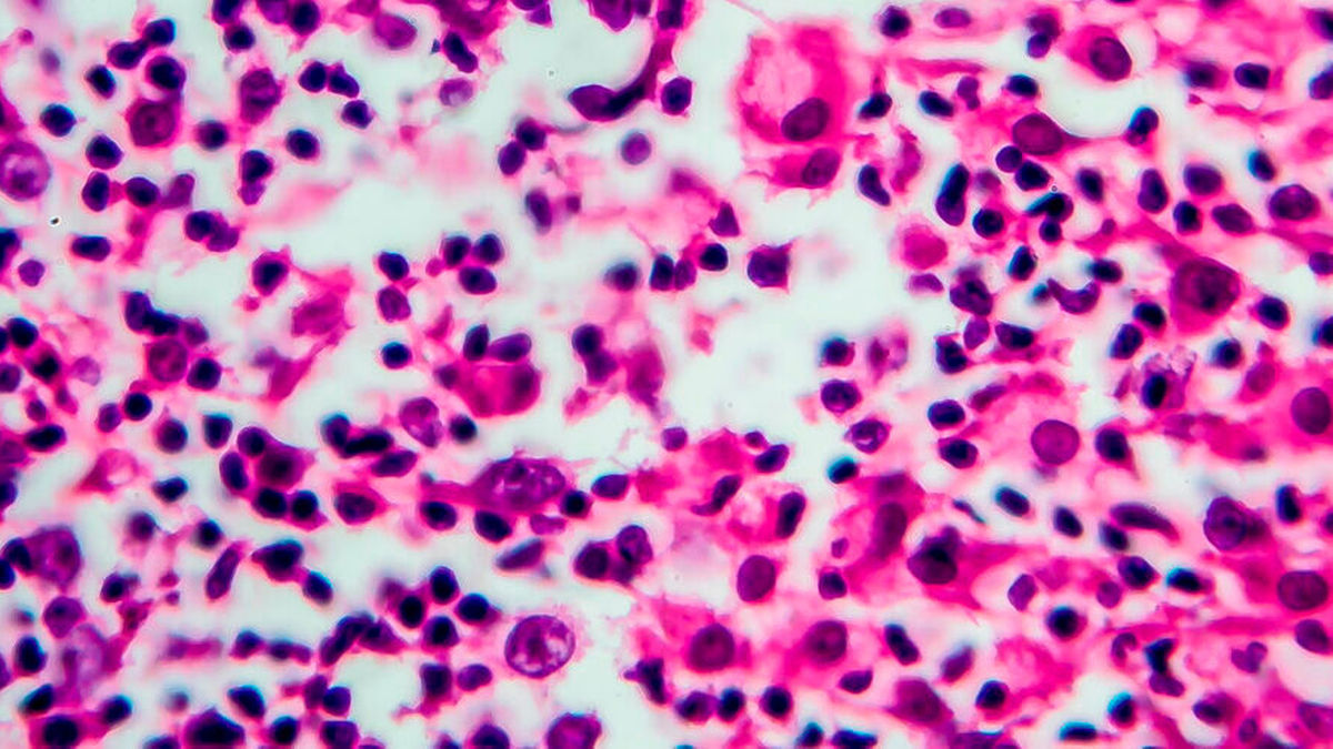 Fortgeschrittenes cHL: Pembrolizumab vor Chemotherapie vielversprechend