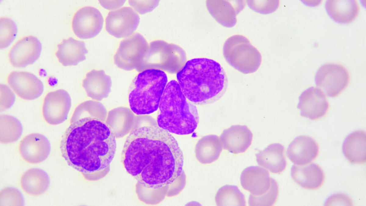 CLL mit del(17p): Langzeit-Wirksamkeit von Venetoclax bestätigt