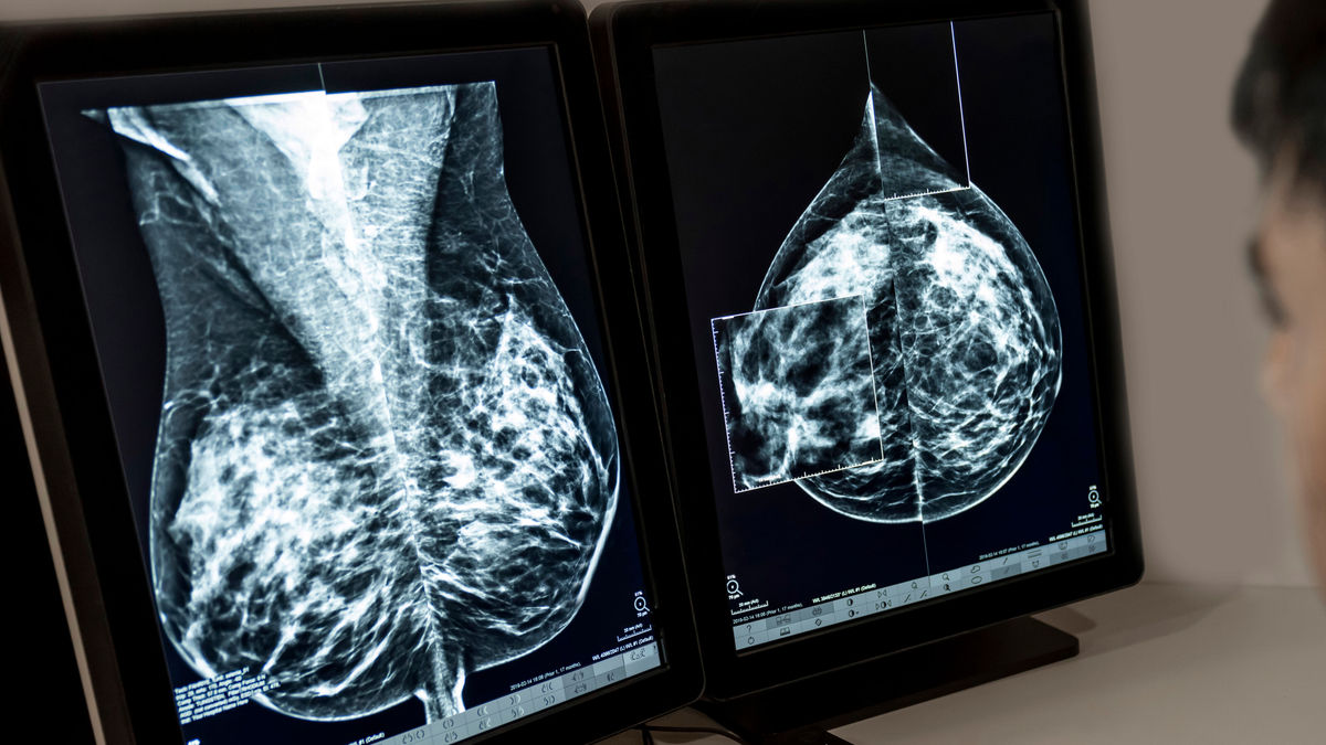 Schne Mammographie Ergebnis Sofort Ebenbild