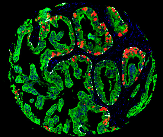 Schnitt durch das Gewebe einer Prostatabiopsie. Prostatazellen sind grün gefärbt, rote und weiße Bereiche stellen tumorrelevante Veränderungen in Prostatakrebszellen dar. (© Niclas Blessing/UKE)