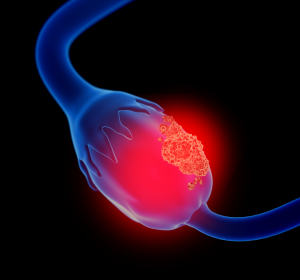 PFS beim Ovarialkarzinom unter Niraparib signifikant verlängert