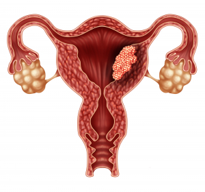 Aktuelle Studienergebnisse beim fortgeschrittenen Endometriumkarzinom vom virtuellen Kongress der SGO 2020*