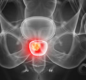 Fokale Therapie des Prostatakarzinoms