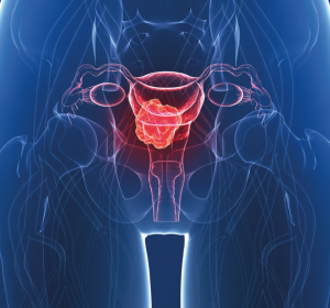 Checkpoint-Inhibition entwickelt sich als neue Option beim Endometriumkarzinom