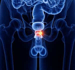 Perioperative Therapie beim Hochrisiko-Prostatakarzinom mit Indikation zur radikalen Prostatektomie