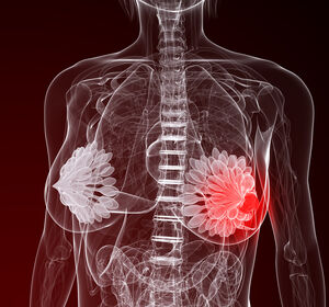 Erstlinienbehandlung mit CDK 4/6-Inhibitoren zeigt Überlebensvorteil bei metastasiertem Brustkrebs