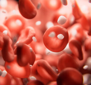 Luspatercept bei Niedrigrisiko-MDS: Klinischer Benefit bei niedriger und hoher Baseline-Transfusionslast