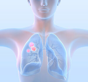 Lungenkarzinom: Endlich eine Perspektive beim fortgeschrittenen Kleinzeller