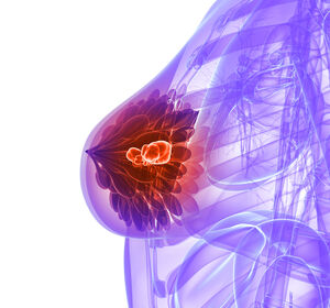 HR+/HER2- fortgeschrittener Brustkrebs: Mit Sacituzumab Govitecan länger progressionsfrei überleben