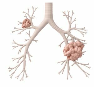 Lungenkarzinom: Immuntherapie, zielgerichtete Therapie und Chemotherapie