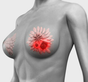 HR+, HER2- fortgeschrittener Brustkrebs: Zweite Zwischenanalyse der MONARCH 3 Studie