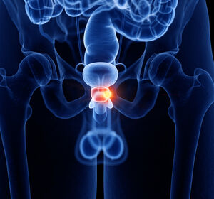 Erst- oder Zweitlinientherapie beim metastasierten hormonsensitiven Prostatakarzinom