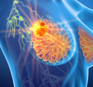 Addition von Ribociclib zur ET reduziert Rezidivrisiko bei frühem HR+/HER2– Brustkrebs im adjuvanten Setting