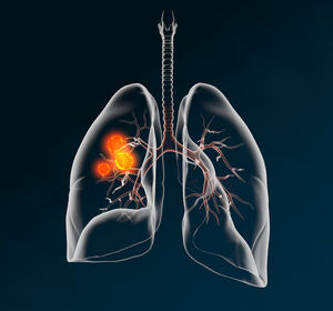 Lungenkrebs in Verbindung mit idiopathischer Lungenfibrose: Herausforderungen und Perspektiven