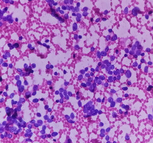Therapie des diffusen großzelligen B-Zell-Lymphoms: Bispezifischer Antikörper erzielt mOS von 19,4 Monaten