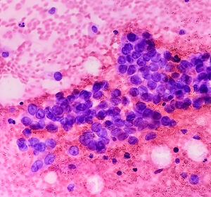 Erstlinientherapie des metastasierten nicht-kleinzelligen Lungenkarzinoms: Einfluss nicht-adressierbarer Risiko-Mutationen auf immunonkologische Kombinationstherapien