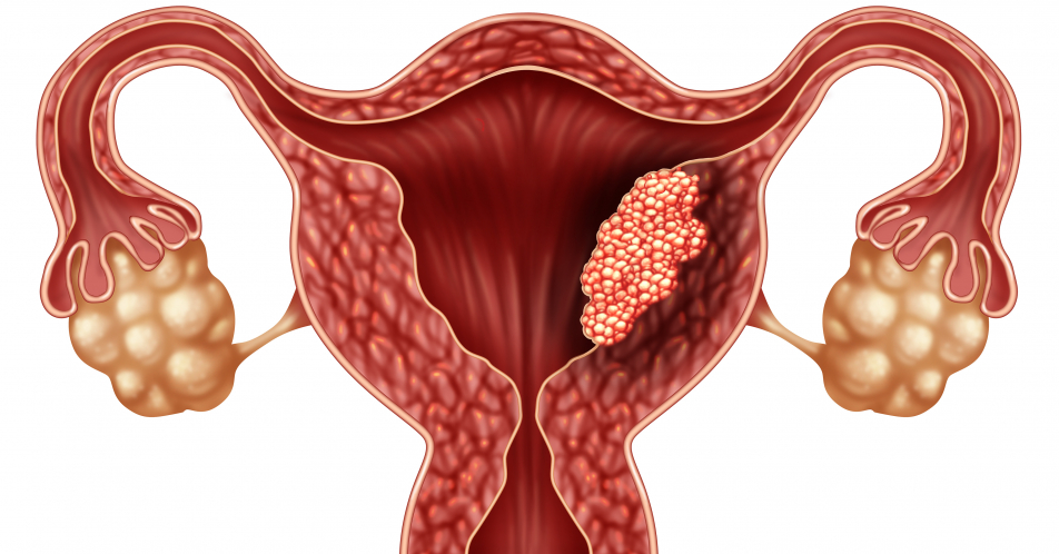 Aktuelle Studienergebnisse beim fortgeschrittenen Endometriumkarzinom vom virtuellen Kongress der SGO 2020*