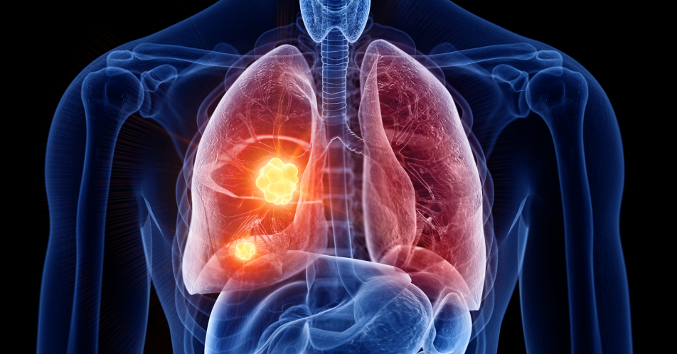 Metastasiertes Lungenkarzinom: Aktueller Stand der medikamentösen Therapie