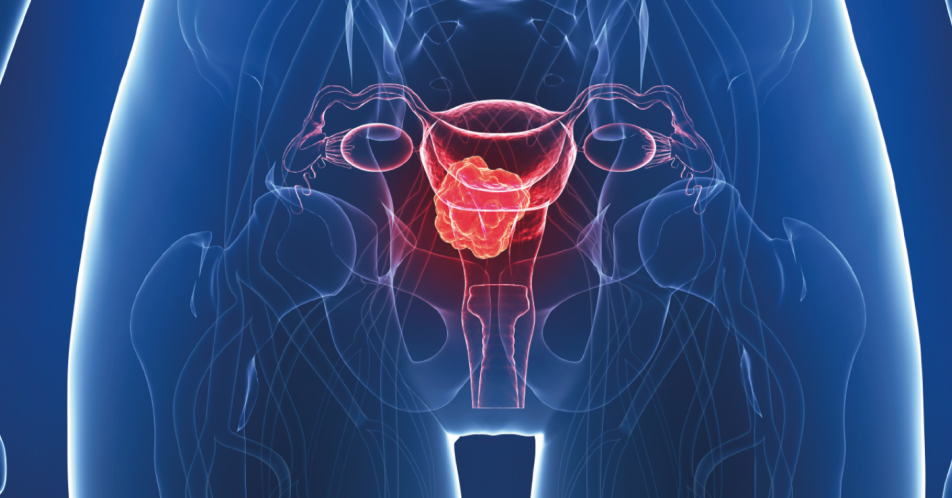 Checkpoint-Inhibition entwickelt sich als neue Option beim Endometriumkarzinom