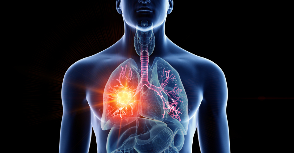 Strahlentherapie des kleinzelligen Lungen­karzinoms – Indikation und Verträglichkeit