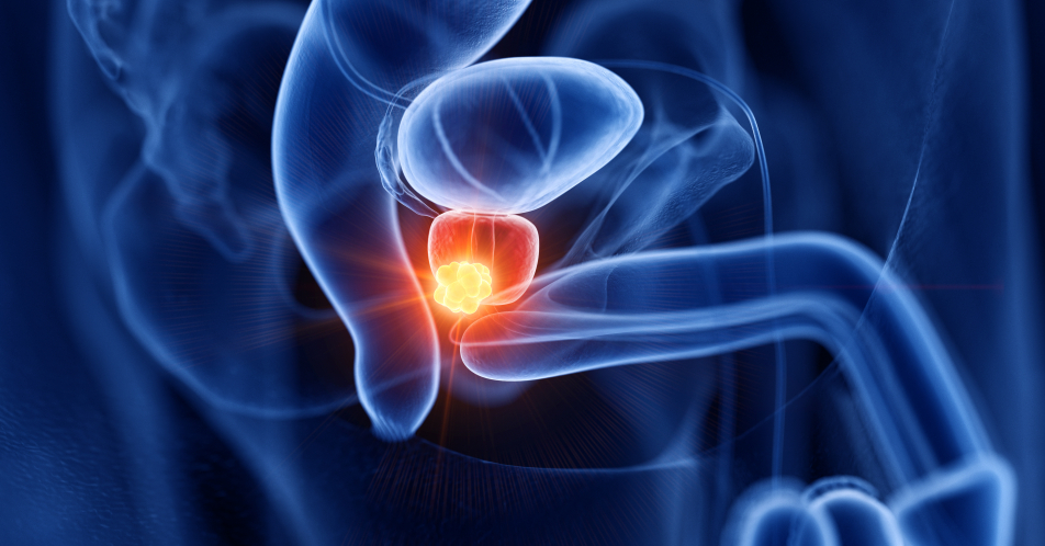 Nicht-metastasiertes Prostatakarzinom: Diagnostik und Therapie