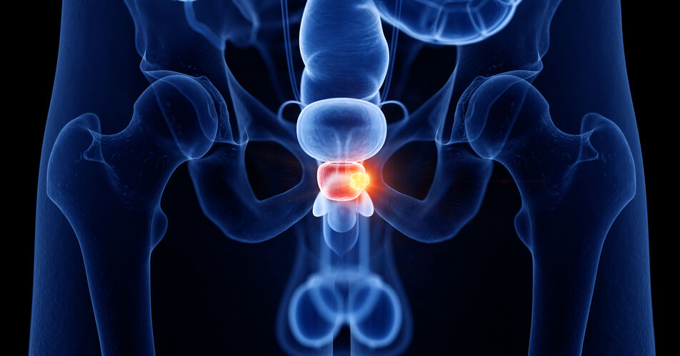 Perioperative Therapie beim Hochrisiko-Prostatakarzinom mit Indikation zur radikalen Prostatektomie