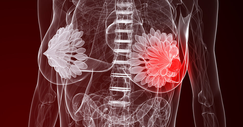 Erstlinienbehandlung mit CDK 4/6-Inhibitoren zeigt Überlebensvorteil bei metastasiertem Brustkrebs