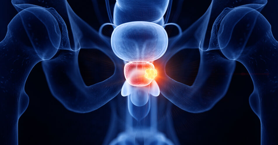 Zweitlinientherapie beim metastasierten kastrationsrefraktären Prostatakarzinom