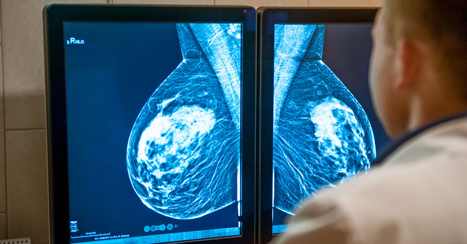 Neue Altersgrenzen beim Mammographie-Screening – was bedeutet dies für die gynäko-onkologische Praxis?