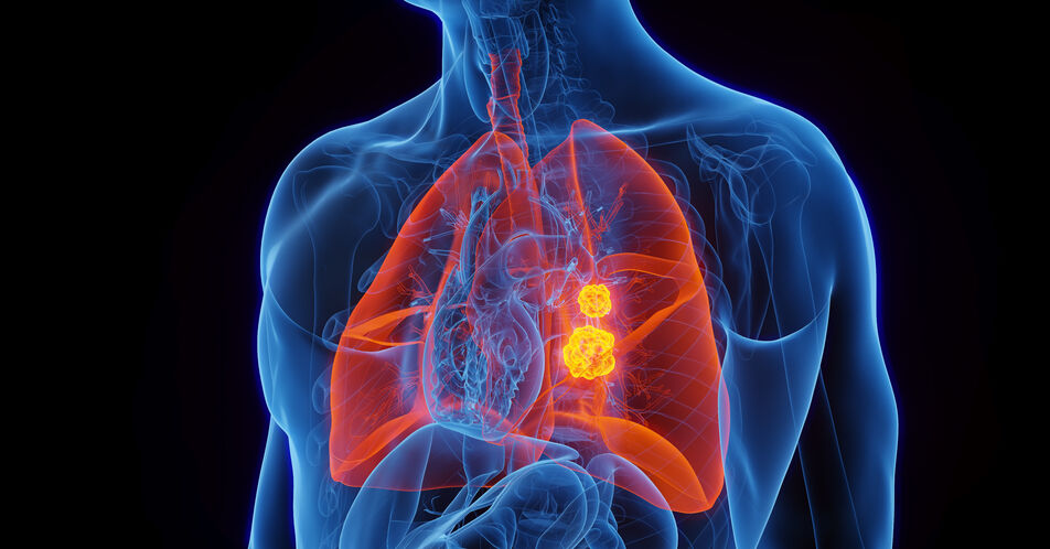 Metastasiertes nicht-kleinzelliges Lungenkarzinom: POSEIDON-Regime besonders bei Risiko-Mutationen vorteilhaft
