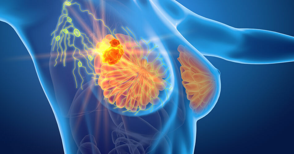 Addition von Ribociclib zur ET reduziert Rezidivrisiko bei frühem HR+/HER2– Brustkrebs im adjuvanten Setting