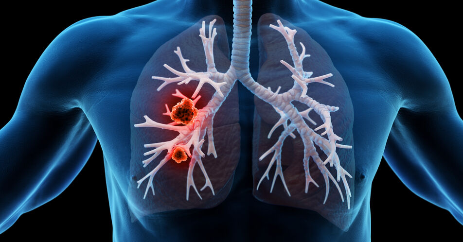 Fortgeschrittenes kleinzelliges Lungenkarzinom: Leitliniengerechte Standardtherapie mit Durvalumab kann Überleben signifikant verlängern