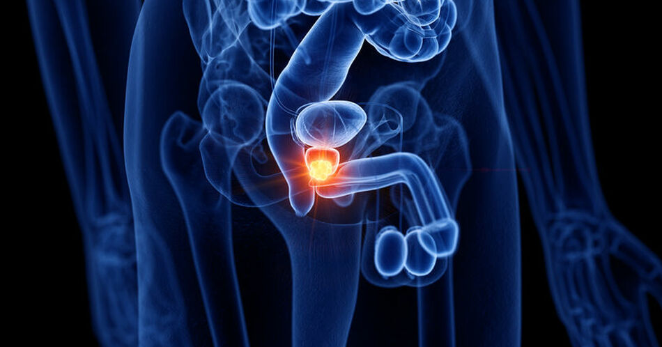 Fortgeschrittenes Prostatakarzinom: PSMA-Theranostik – Immer wichtiger in Diagnostik und Therapie