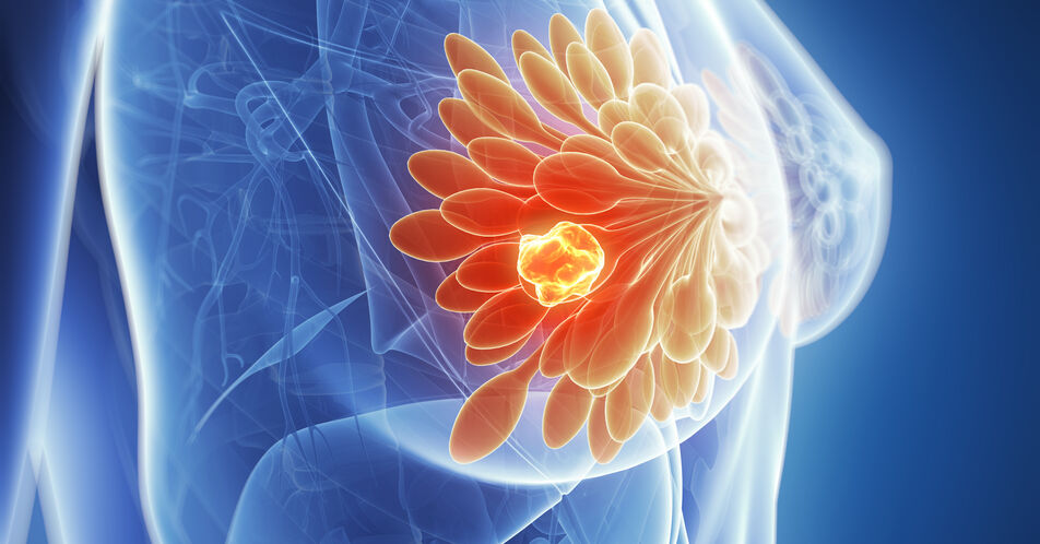 Mammakarzinom: Subkutane Krebstherapien ­eröffnen neue Möglichkeiten