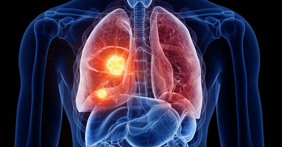 Immuntherapie eröffnet völlig neue Chancen beim frühen Lungenkarzinom