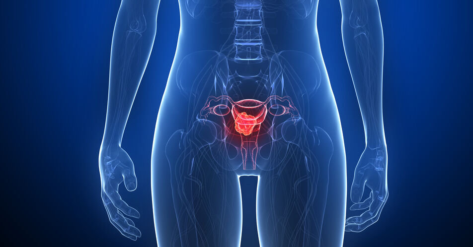 Gebärmutterkörperkrebs (Endometriumkarzinom)