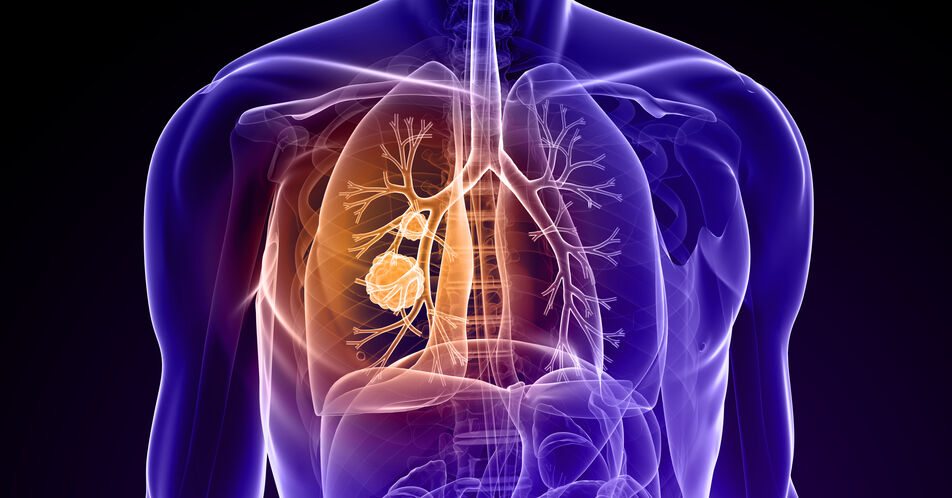 NSCLC – Ein Überblick über das nicht-kleinzellige Lungenkarzinom