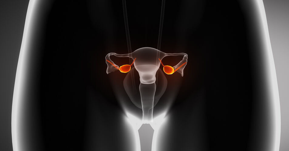 Eierstockkrebs (Ovarialkarzinom)