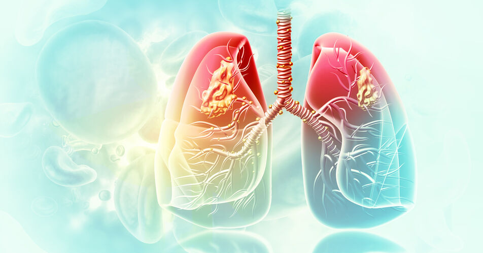 SCLC – Ein Überblick über das kleinzellige Lungenkarzinom