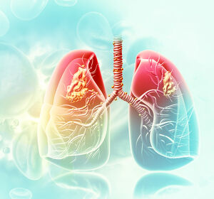 SCLC – Ein Überblick über das kleinzellige Lungenkarzinom
