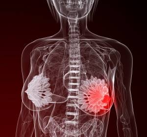 HR+/HER2- metastasierter Brustkrebs: Neu zugelassenes Palbociclib verlängert in Kombination mit Letrozol das PFS
