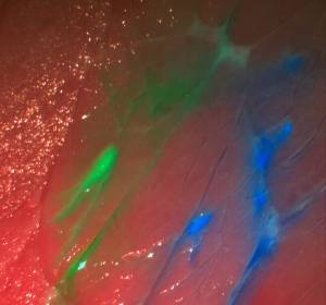 Kamerasystem zeigt Tumore farbig an