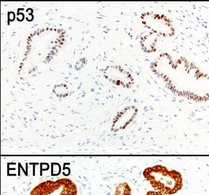 Rolle von p53-Mutationen bei der Metastasierung