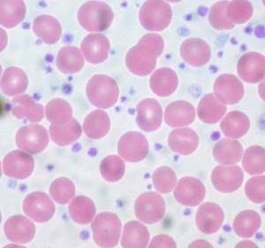 MPN: Neben Stammzellen auch T-Zellen von Mutationen betroffen