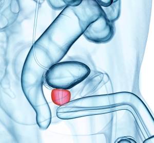 Metastasiertes Prostatakarzinom: Bessere Prognose bei frühzeitiger Chemotherapie  