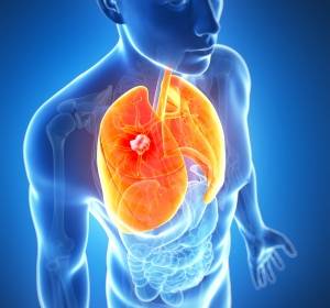 Osimertinib verbessert PFS bei Lungenkrebs signifikant