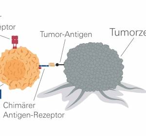 Immuntherapie mit CAR-T Zellen beim Multiplen Myelom