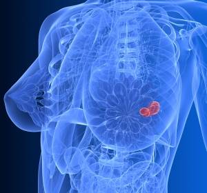 BRCA-mutiertes, HER2-negatives, metastasiertes Mammakarzinom: Zulassungsantrag für Olaparib akzeptiert